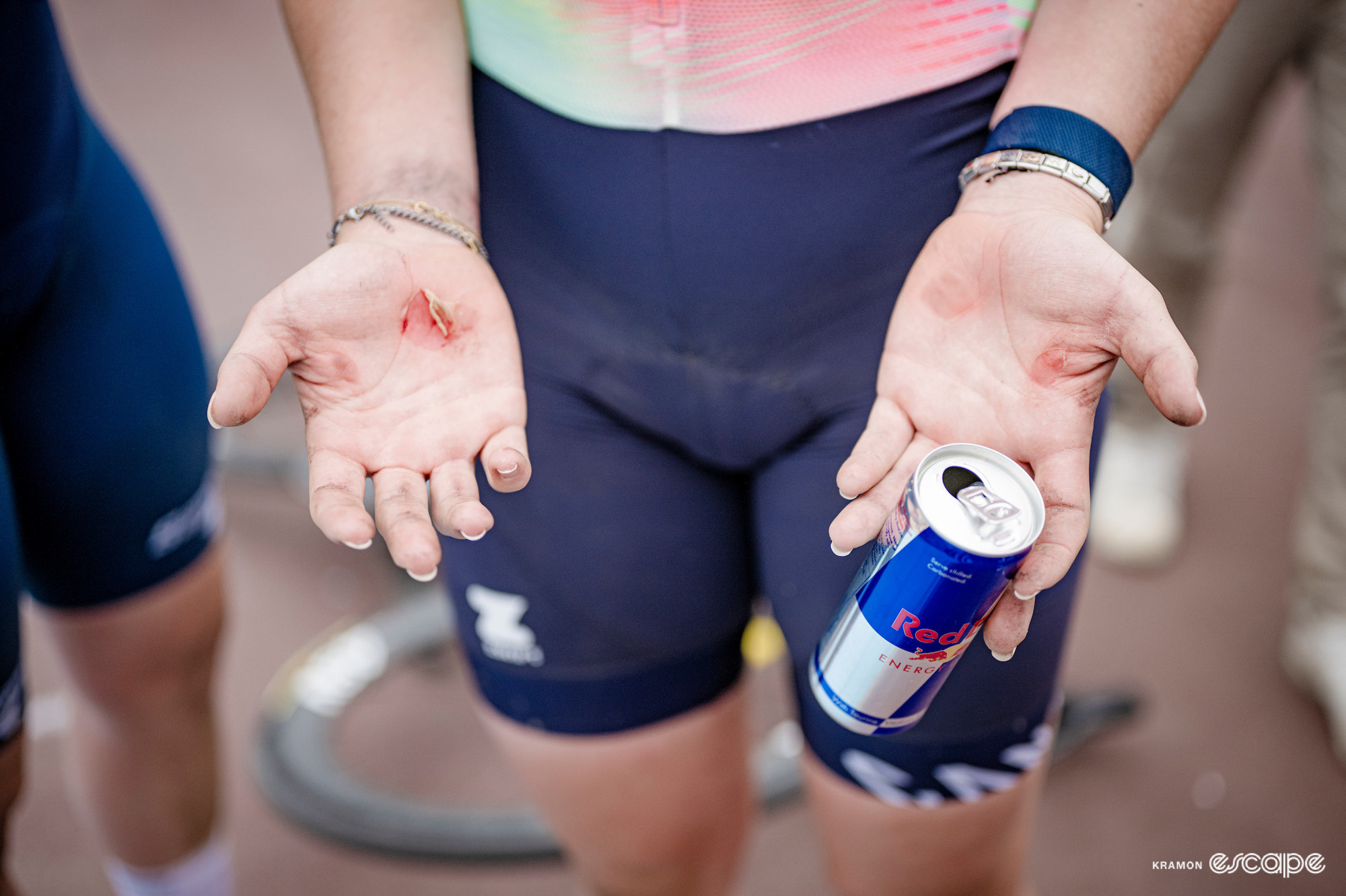 Zoe Backstedt balances a can of Red Bull in one hand as she displays several large, cracked and open blisters on her hands.