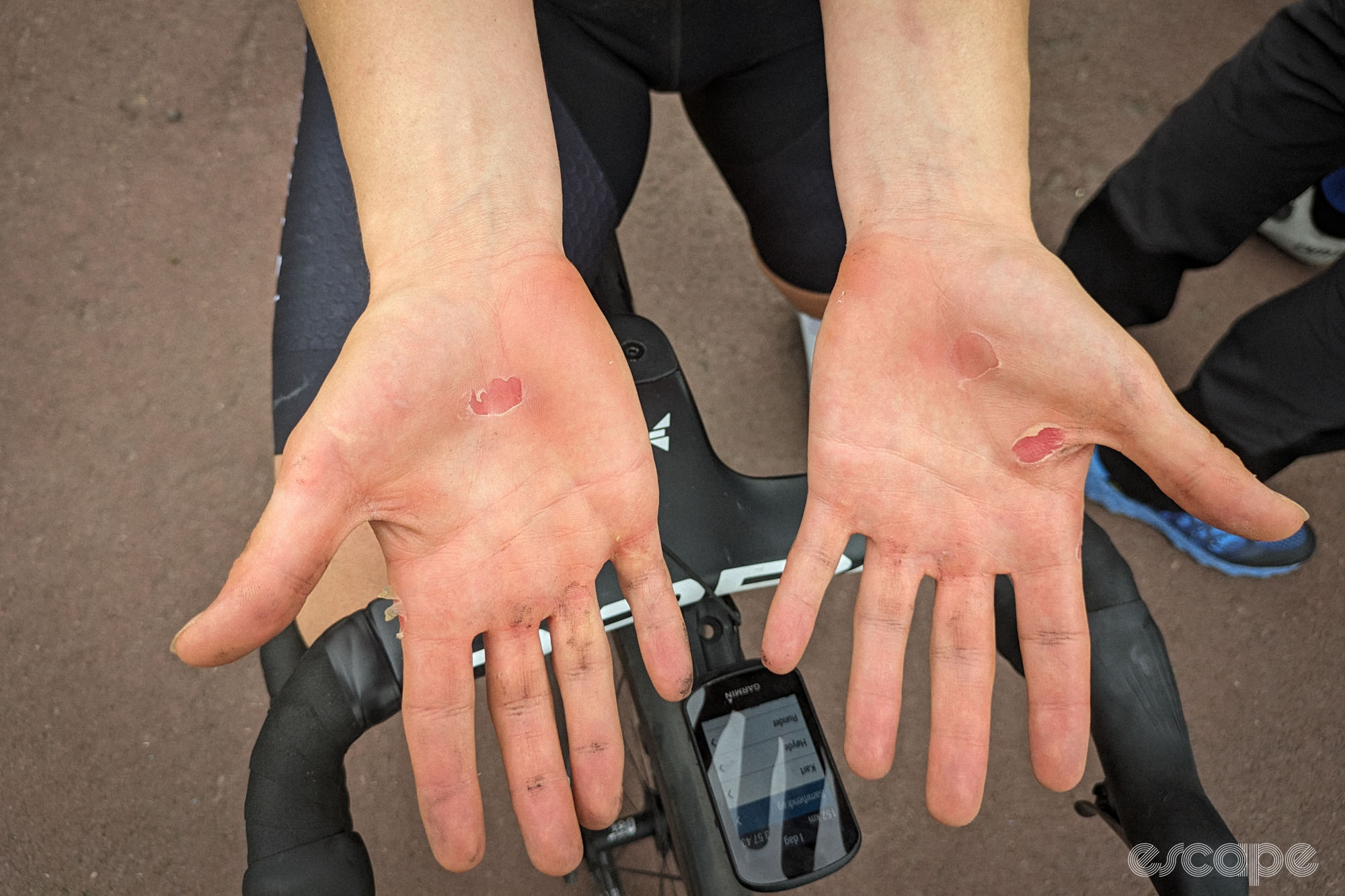 Susanne Andersen displays her hands above her handlebar. Both are dirty and have large, open blisters.