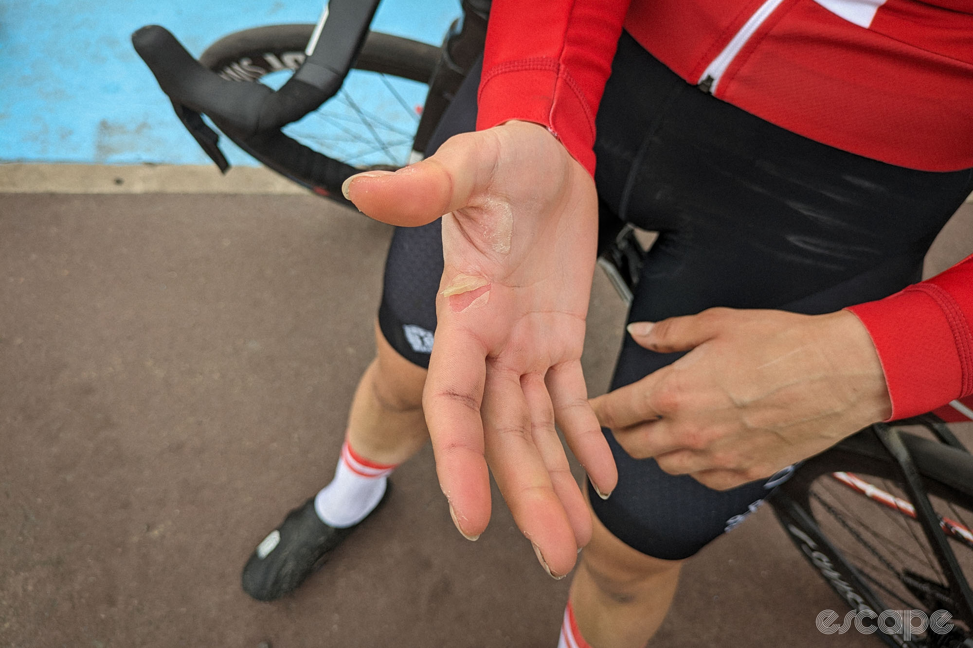 Rebecca Koerner has two large peeling blisters on her right hand between thumb and forefinger where you would grip a brake hood.